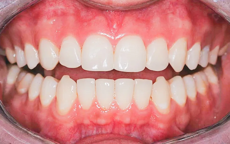 After treatment