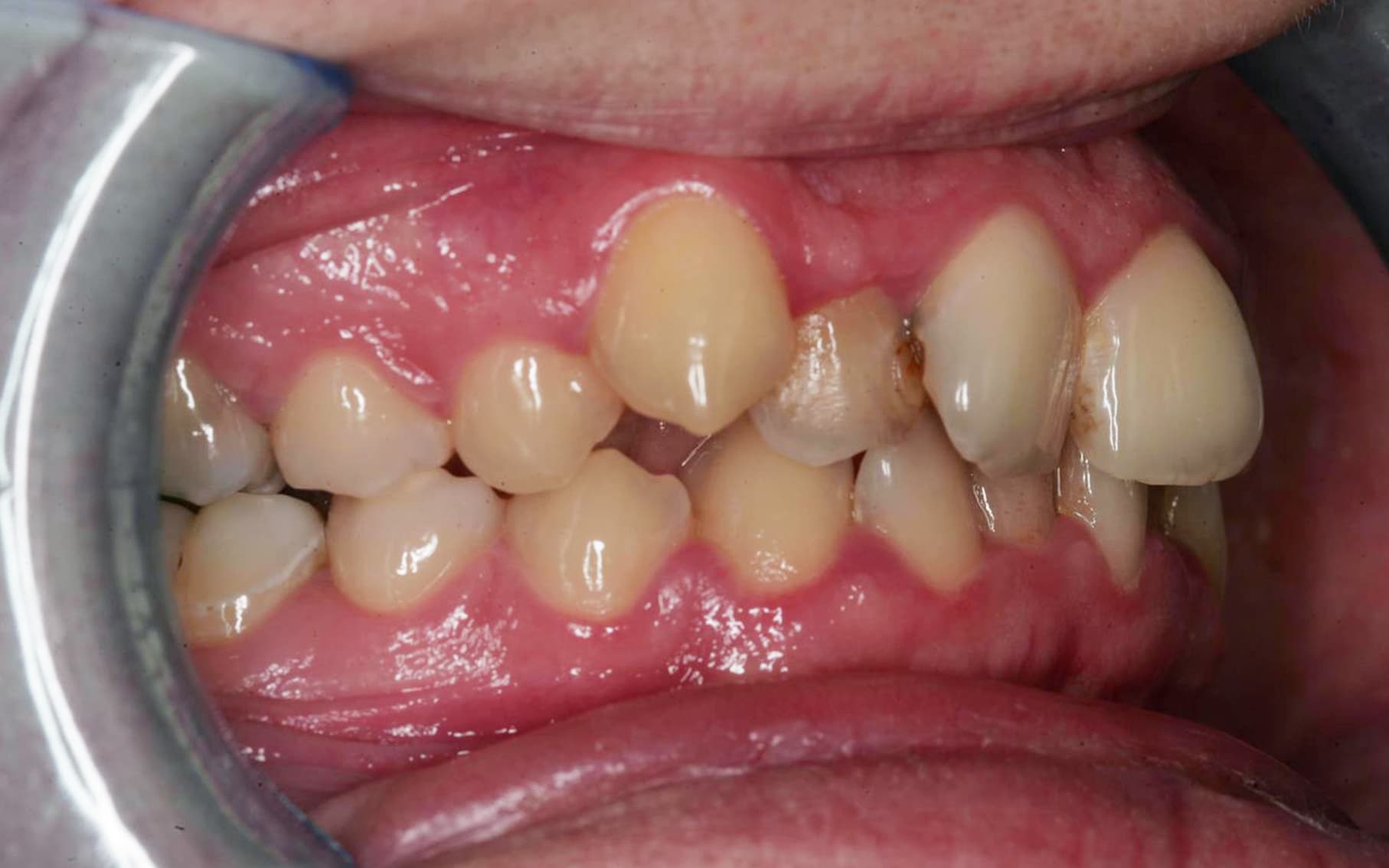 Przed leczeniem