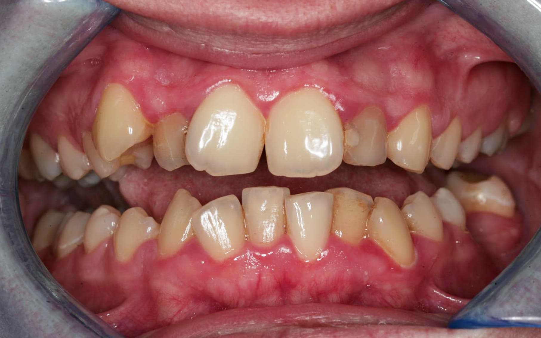 Przed leczeniem