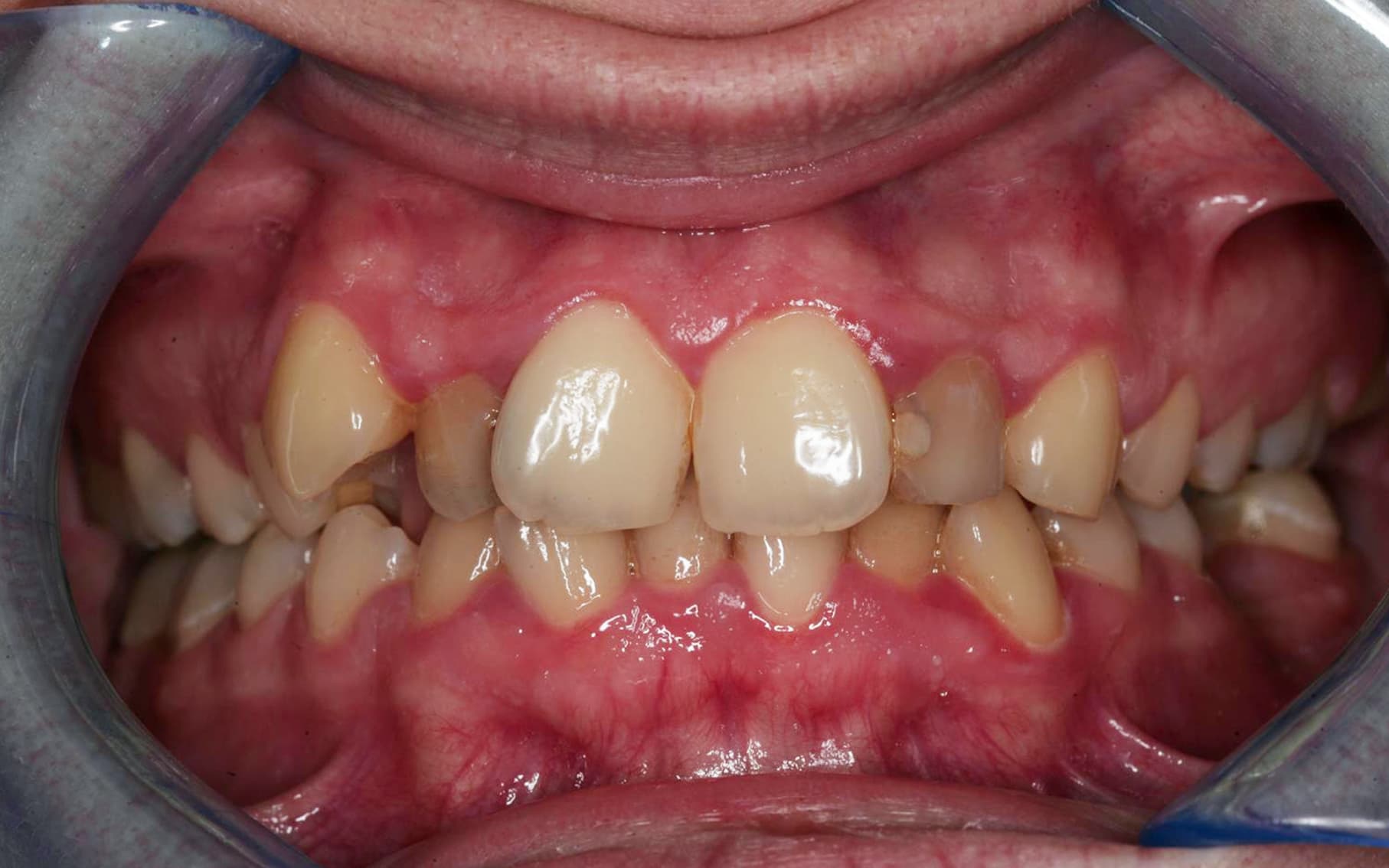 Przed leczeniem