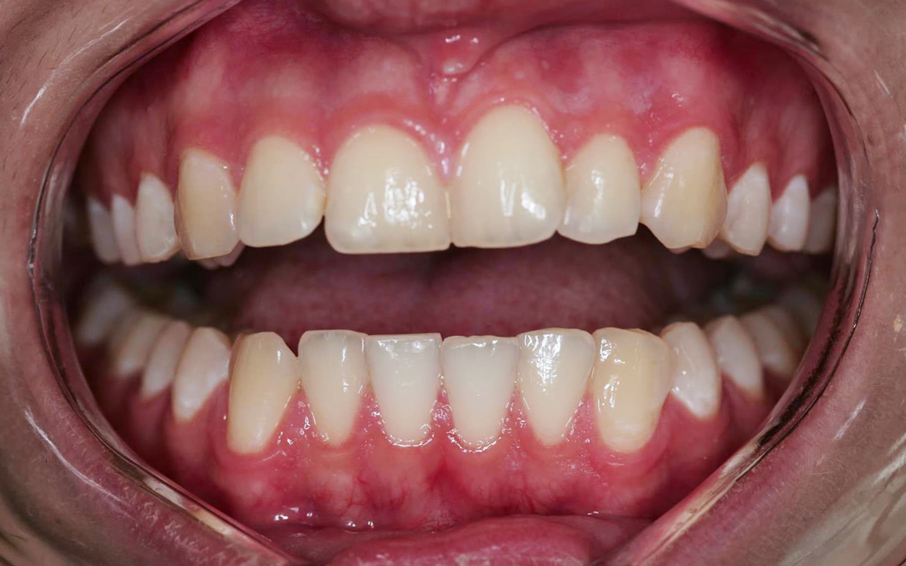 Przed leczeniem