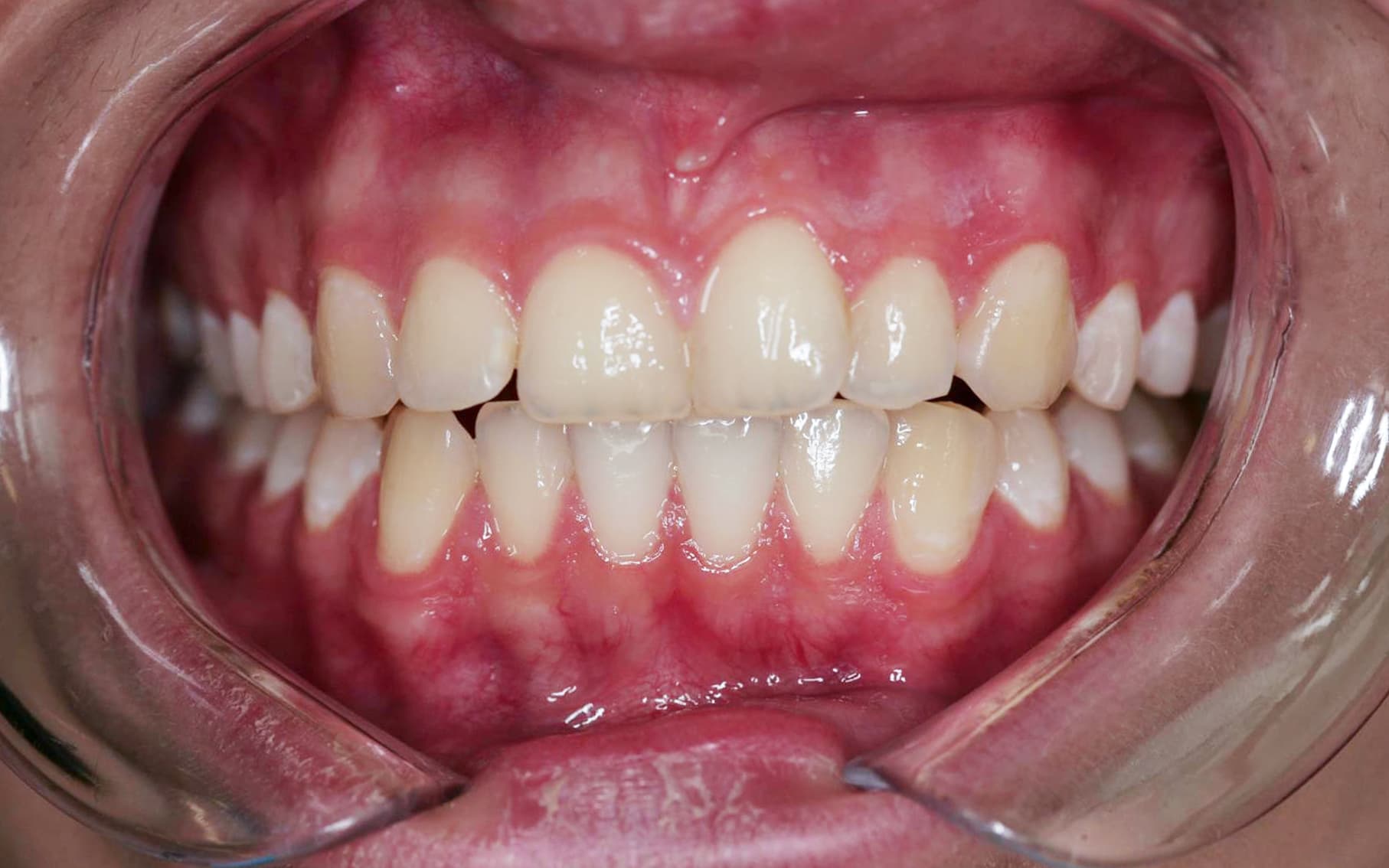Przed leczeniem