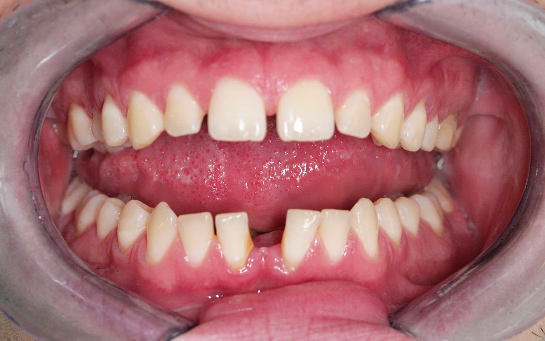 Przed leczeniem