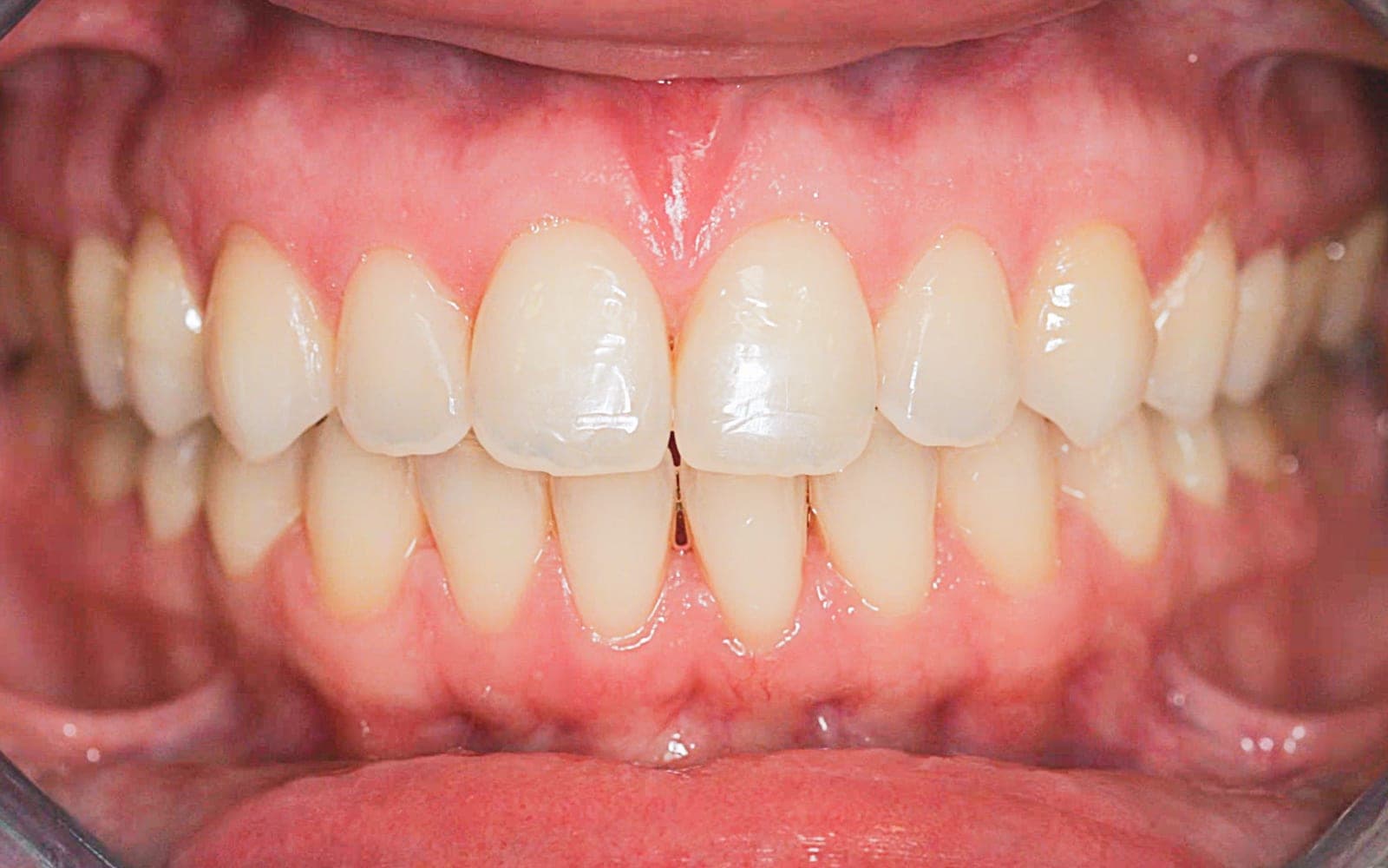 Przed leczeniem