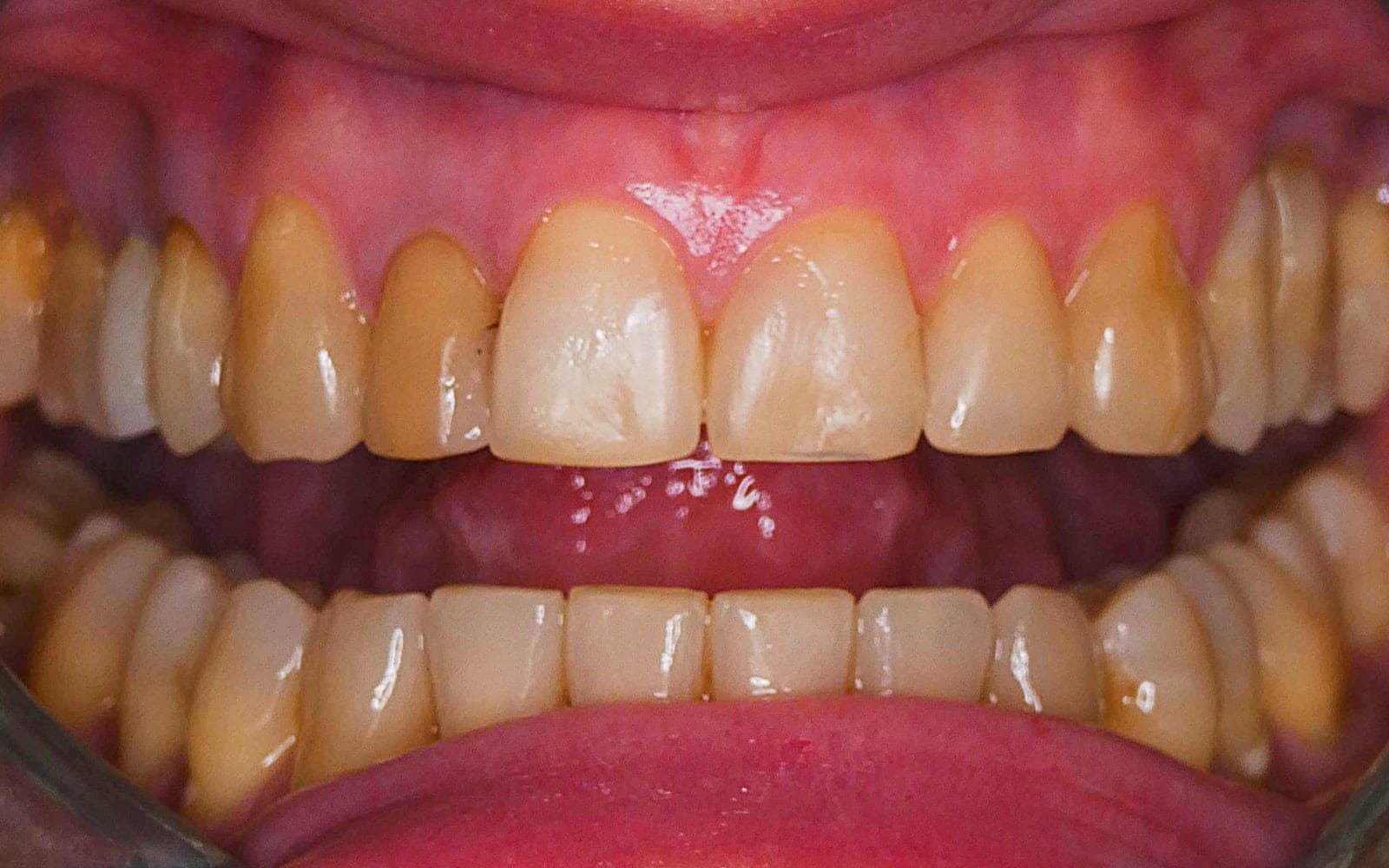 Przed leczeniem