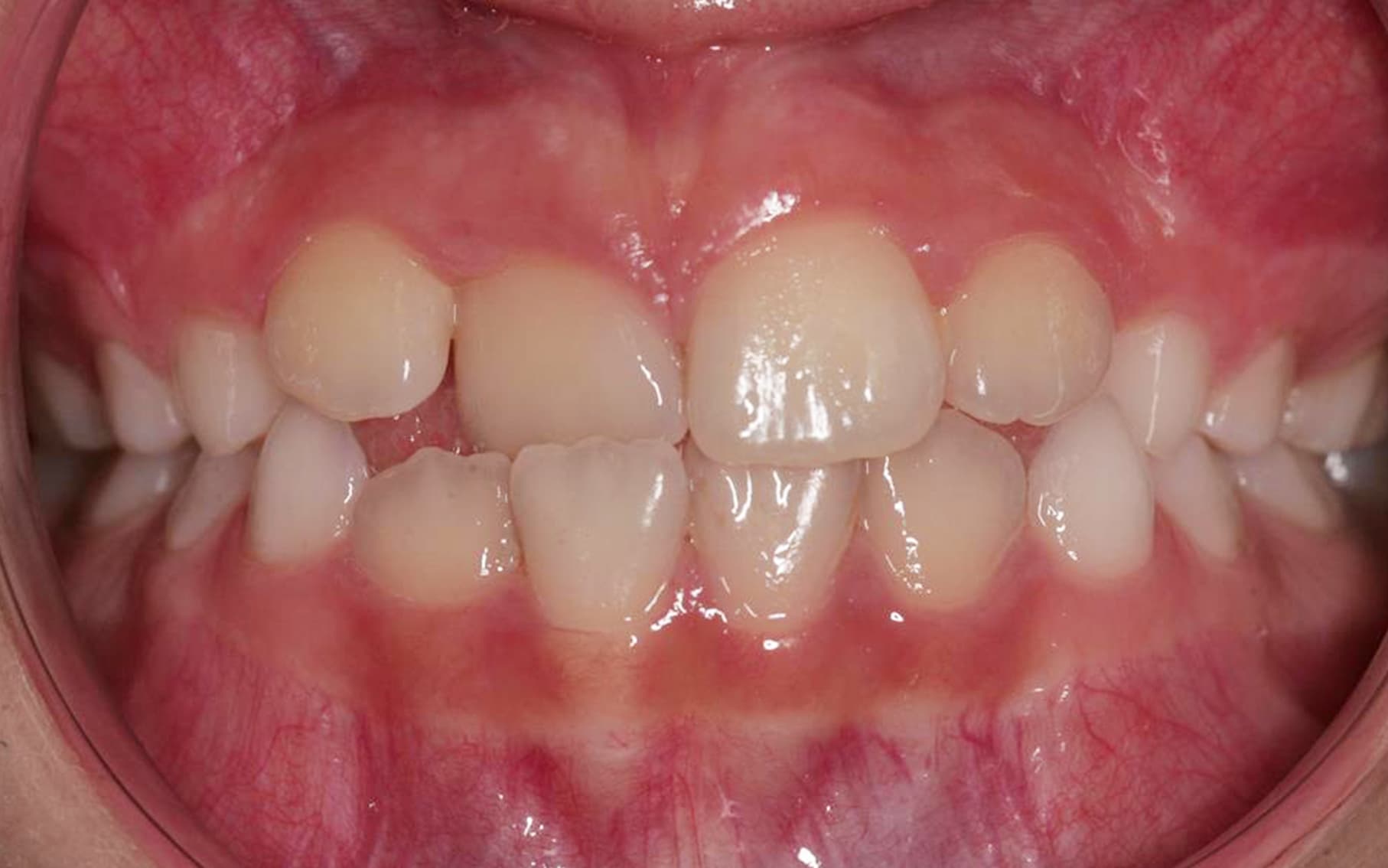 Przed leczeniem