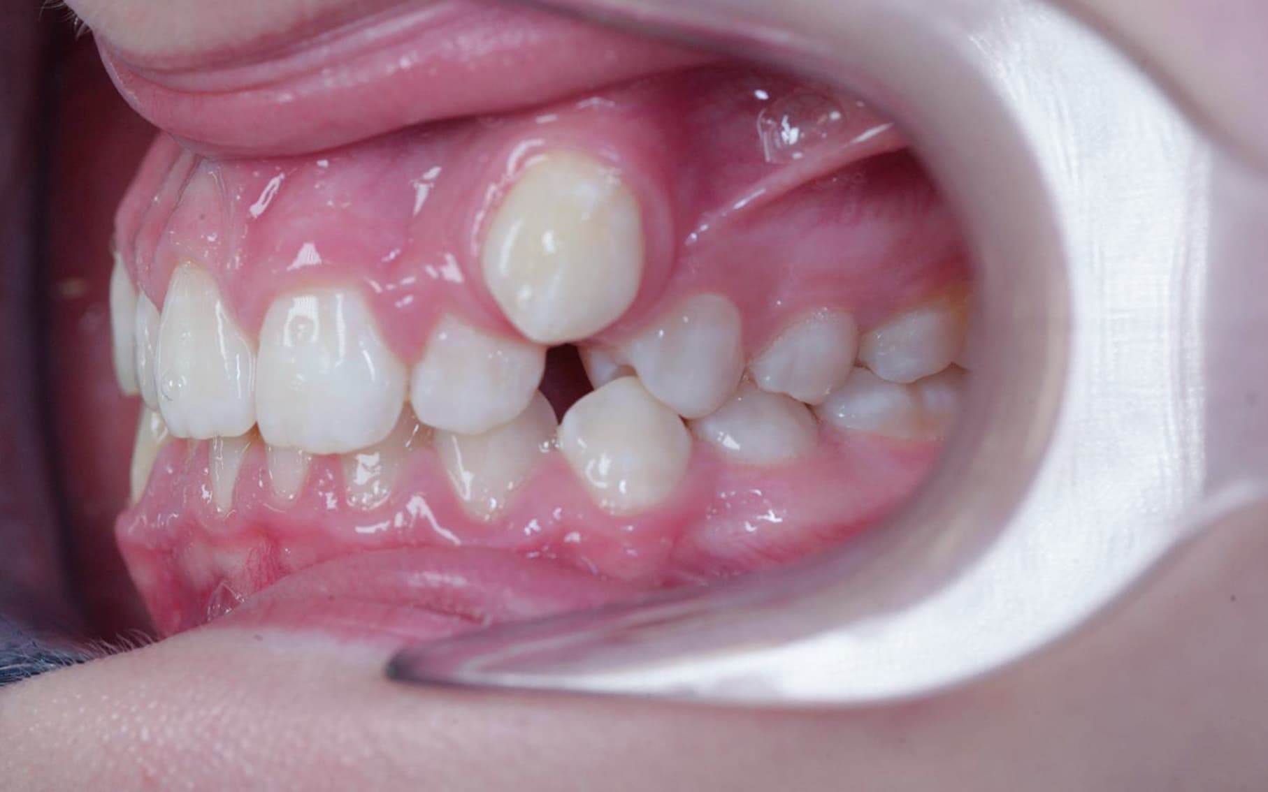 Przed leczeniem