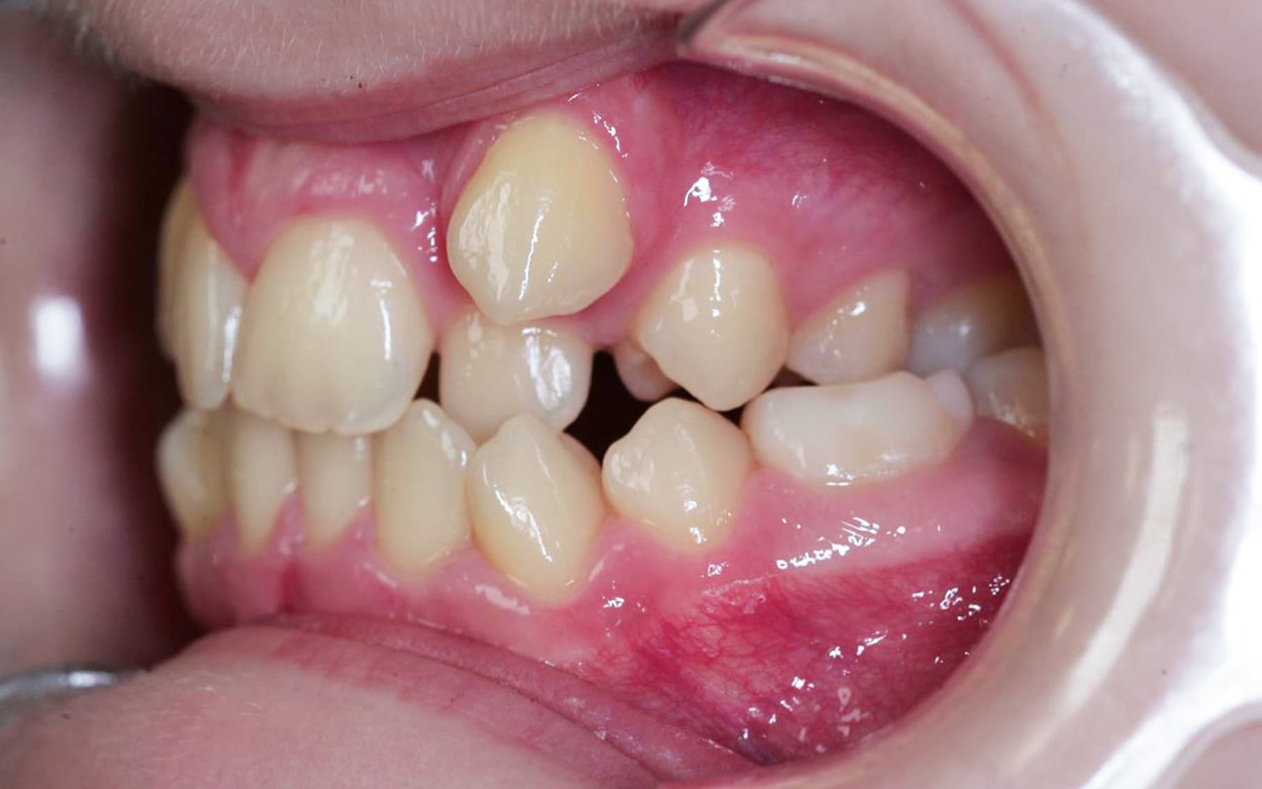 Przed leczeniem