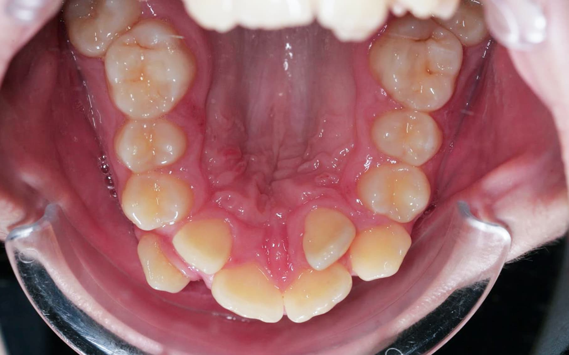 Przed leczeniem