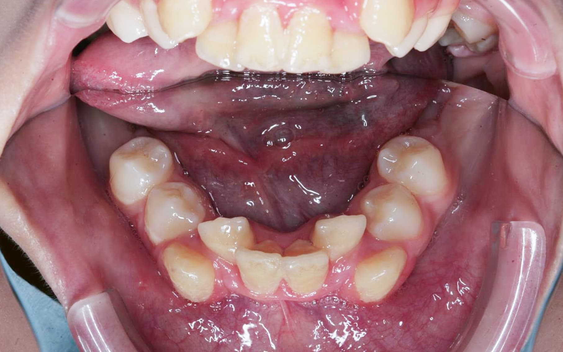 Przed leczeniem