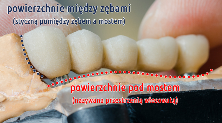 Higiena mostów protetycznych